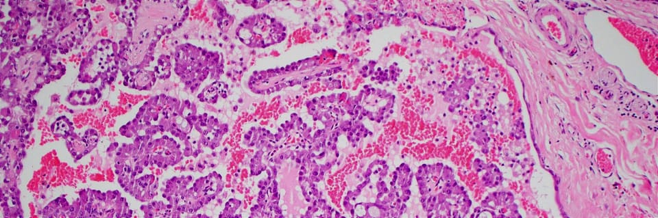 Forpath Seminar - Salivary Gland Tumor Pathology: An Overview